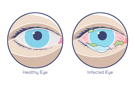 Pink Eye: Usually Mild and Easy to Treat